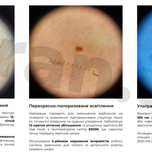 Polarized Dermatoscope with Ultraviolet Light
